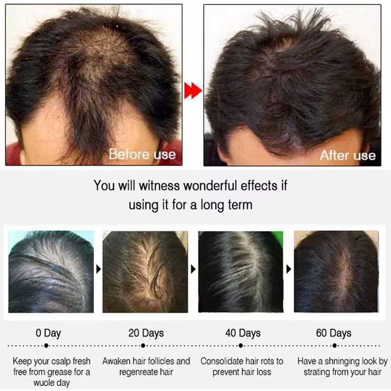 빠른 생강 모발 성장 스프레이, 모발 뿌리 강화, 탈모 - Hair Care Natur 리뷰 및 가격